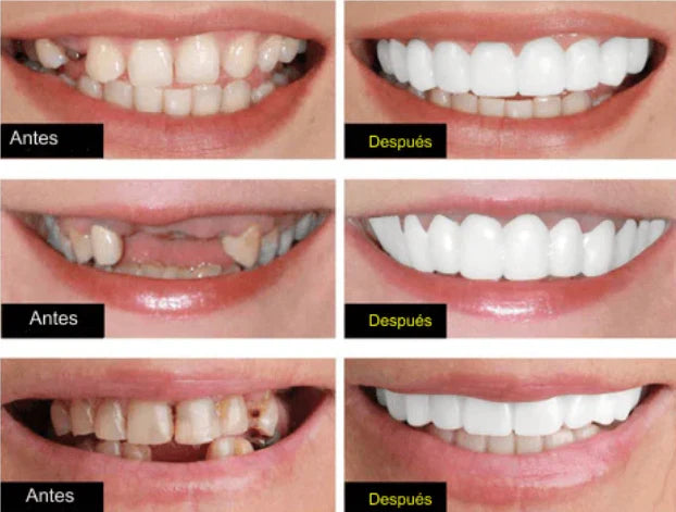 Denwhite®: Carillas Dentales
